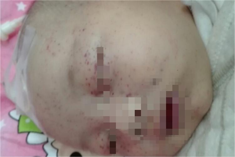 风疹眼周红点图