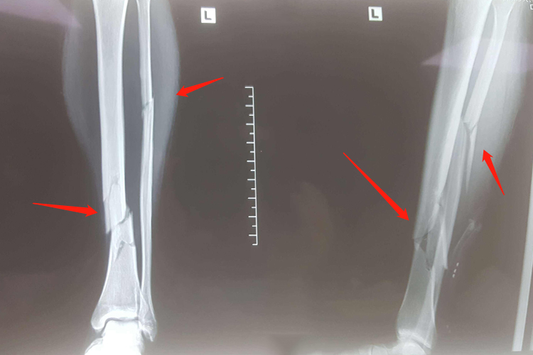 胫骨骨折骨折不愈合图 胫骨骨折骨折不愈合图
