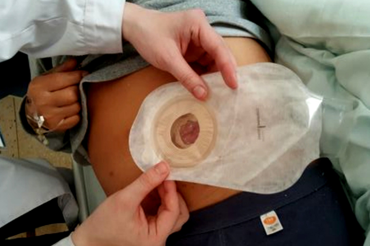 直肠癌肛门改道人工肛门图