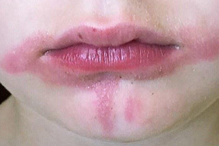 植物光皮炎口周红肿图