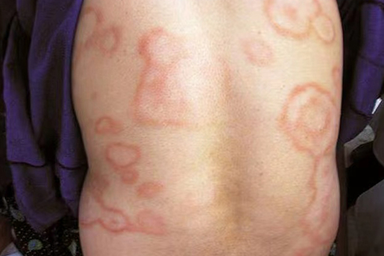 边缘性红斑图 边缘性红斑图