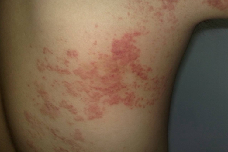 寻常狼疮背部红点图