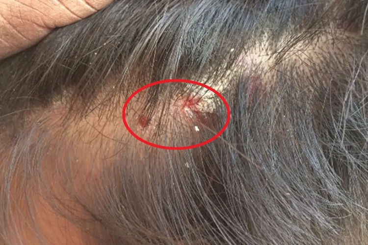头虱叮咬疙瘩图