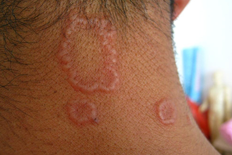 男性艾滋病环状肉芽肿图 男性艾滋病环状肉芽肿图