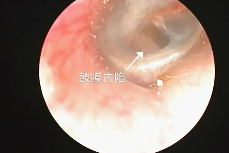鼓膜内陷图