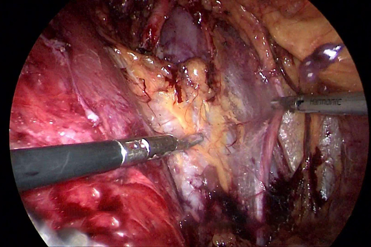 腹腔镜下肾部分切除术图 腹腔镜下肾部分切除术图
