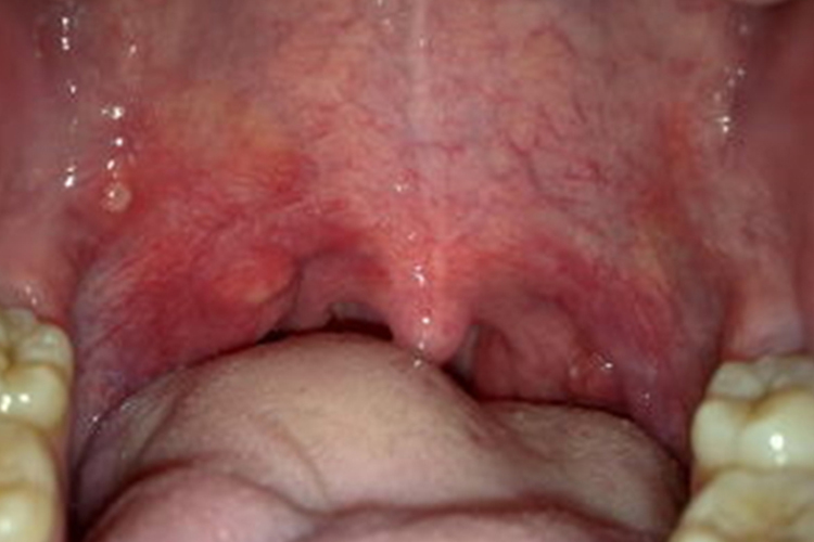 口腔上颚滤泡增生图