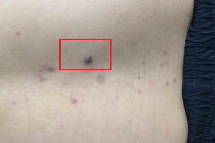 腰部长寻常疣图