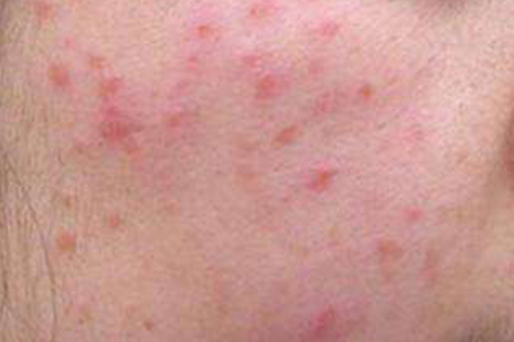 面部急性过敏性皮炎图