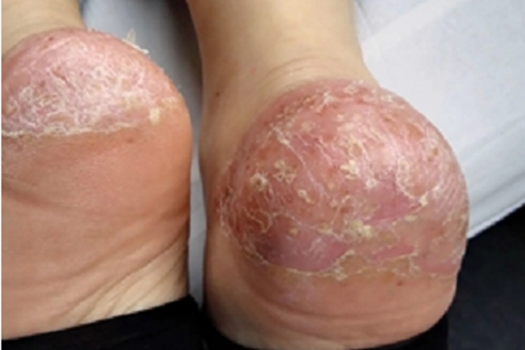 更年期角皮症脚部症状图