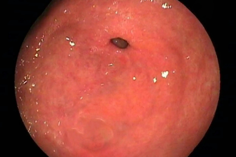 胃窦萎缩内镜图