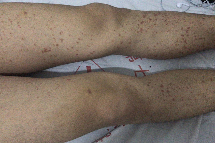 磺胺过敏皮肤紫癜图 磺胺过敏皮肤紫癜图