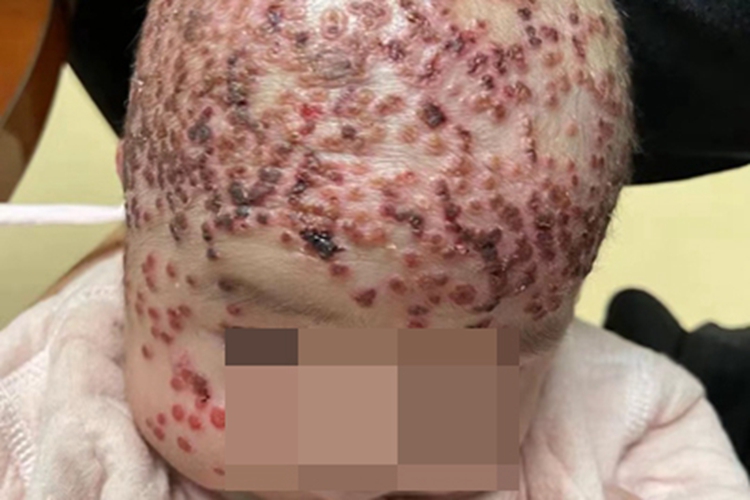 急性湿疹头皮结痂图 急性湿疹头皮结痂图