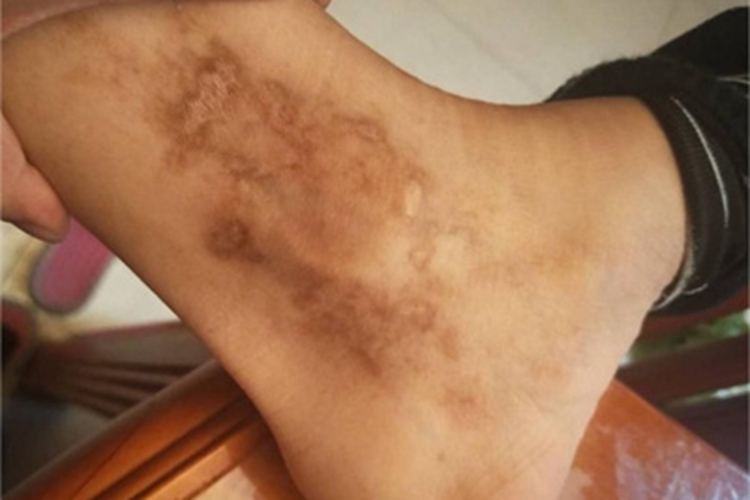 青斑性血管病脚踝有斑块图