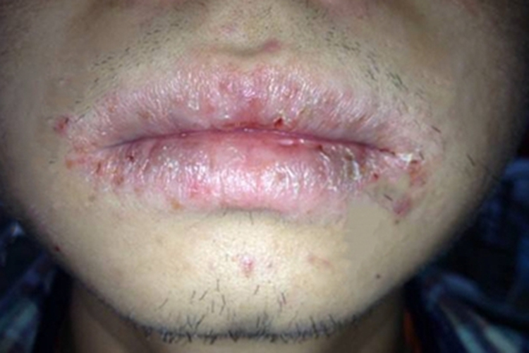 化脓性腺性唇炎嘴唇红肿图