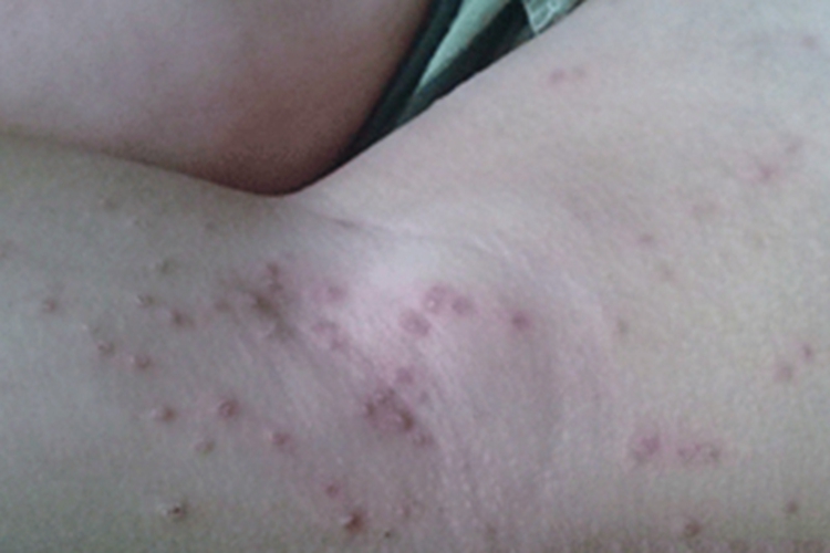 慢性黏膜皮肤念珠菌病腿部丘疹图 慢性黏膜皮肤念珠菌病腿部丘疹图