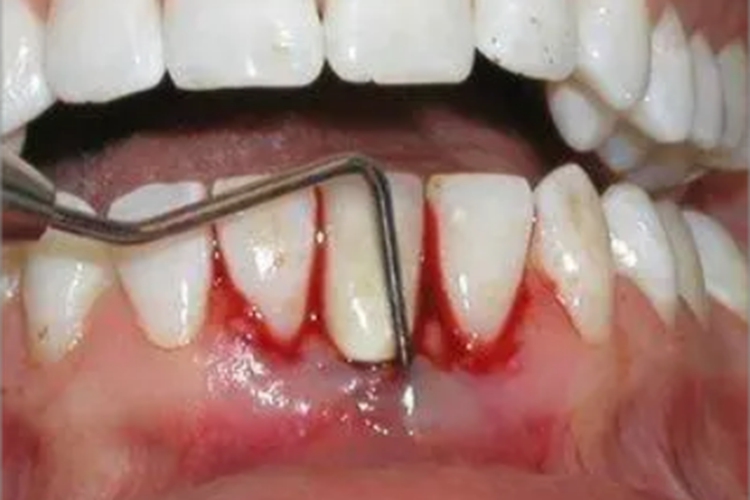 牙周脓肿肿块图 牙周脓肿肿块图