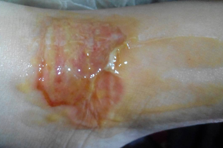 小腿烫伤深Ⅱ度糜烂图