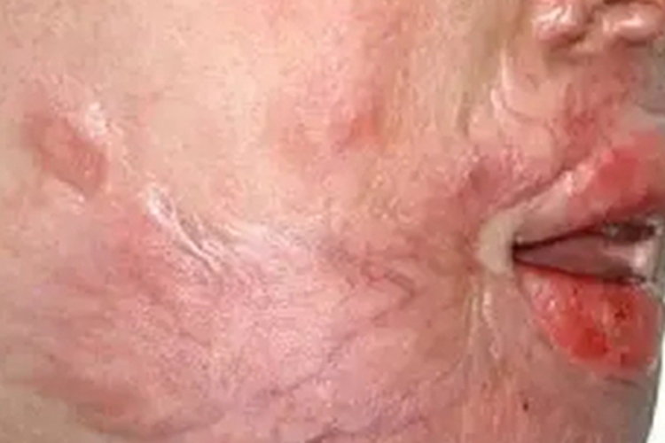 增生性瘢痕面部挛缩增厚图