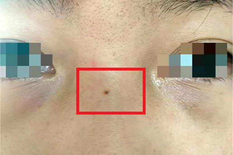 交界痣鼻部黑痣图