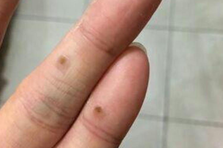 寻常疣早期图