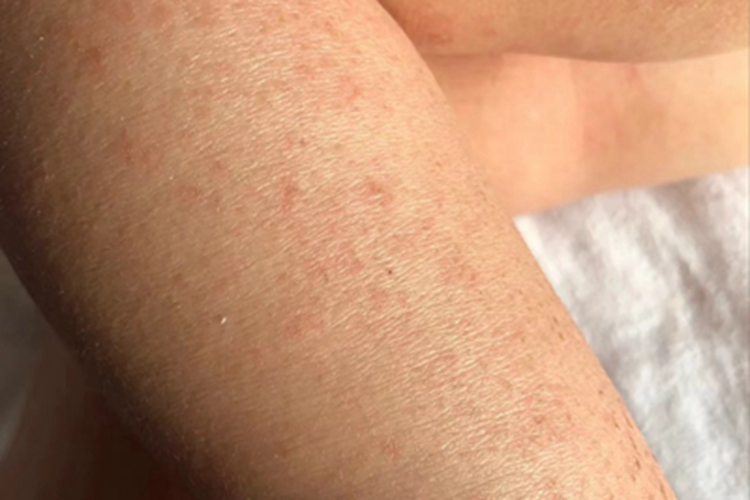 干性湿疹小腿红点图