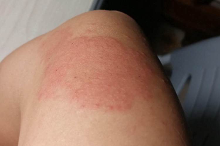 油漆皮炎大腿症状图