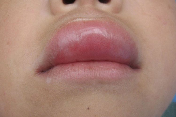 蚝油过敏血管水肿图