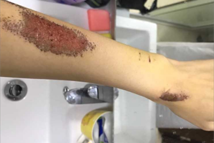 擦伤胳膊结痂图