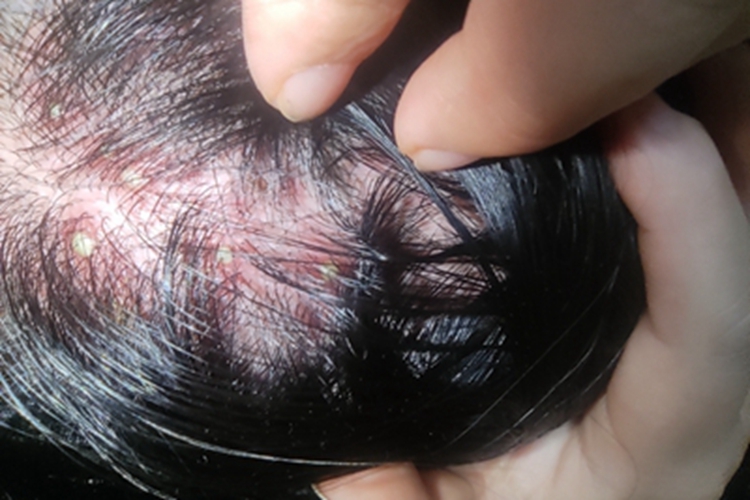 毛囊炎头皮脓包图 毛囊炎头皮脓包图