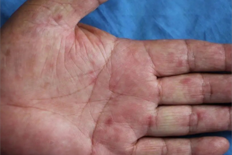 硬红斑手掌有小红斑图 硬红斑手掌有小红斑图