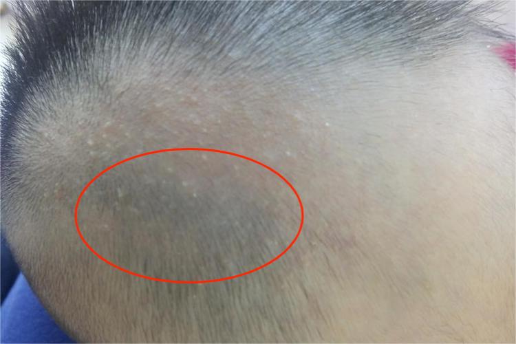 太田痣宝宝头皮蓝灰色斑图