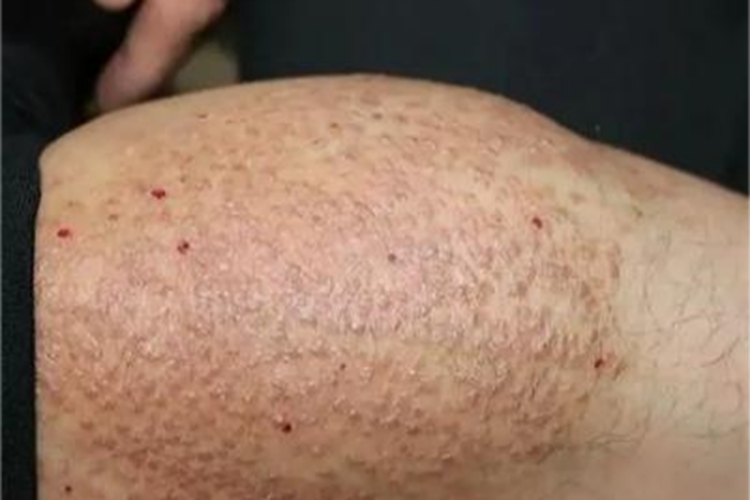 苔藓样淀粉样变病小疙瘩图