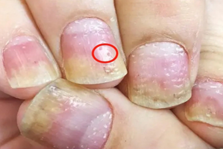 甲凹点指甲有几个坑图 甲凹点指甲有几个坑图