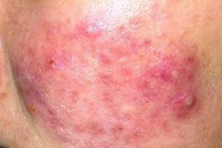 Ⅰ度急性放射性皮炎红斑图