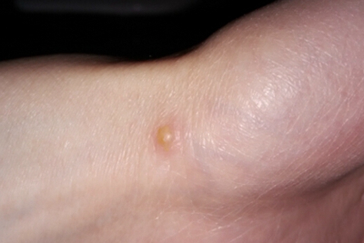 甲虫皮炎手腕症状图