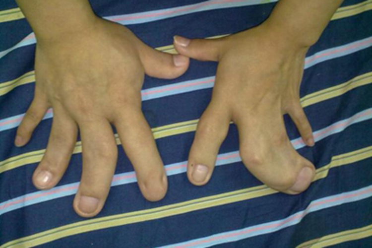 手部先天性畸形手部并指畸形图 手部先天性畸形手部并指畸形图