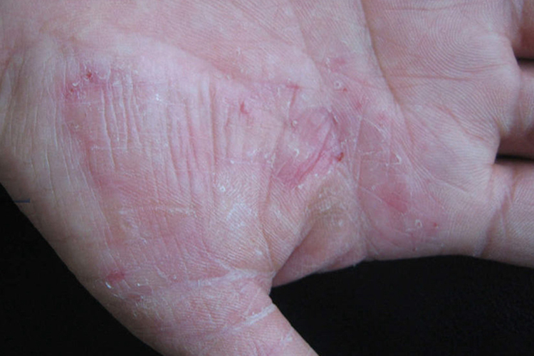 水疱型手癣图