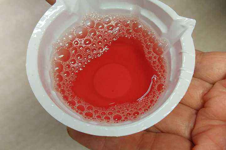 肾型过敏性紫癜血尿图