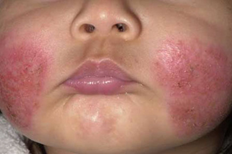 婴儿期特应性皮炎面部红斑图 婴儿期特应性皮炎面部红斑图