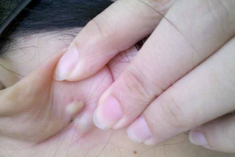 皮脂腺囊肿图 皮脂腺囊肿图