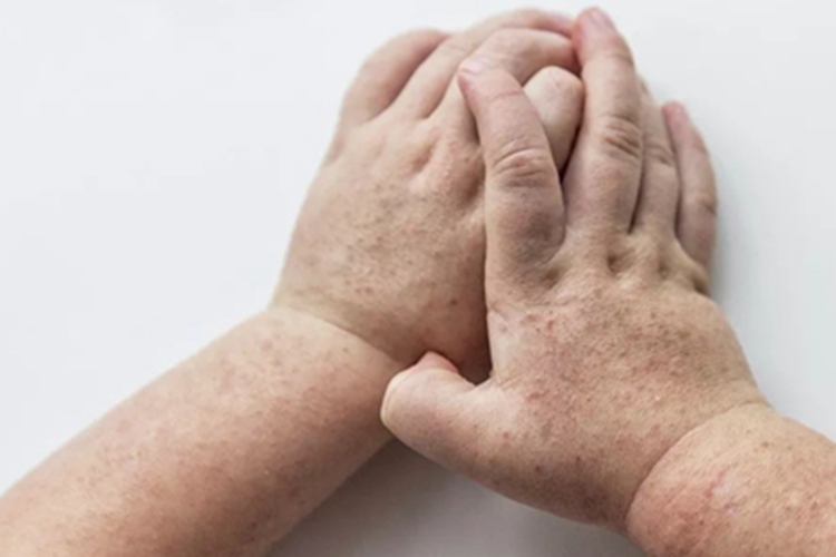 猩红热手背脱屑图 猩红热手背脱屑图