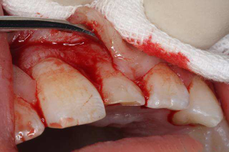 儿童牙龈撕裂伤图
