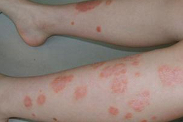 急性点滴型儿童银屑病小腿症状图