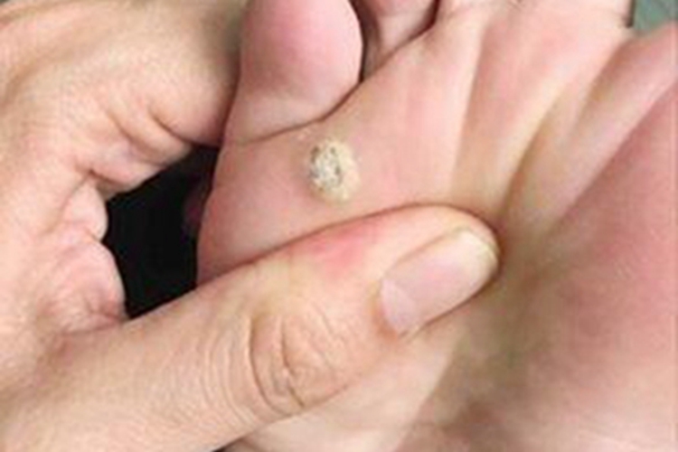 职业性疣赘脚底疙瘩图