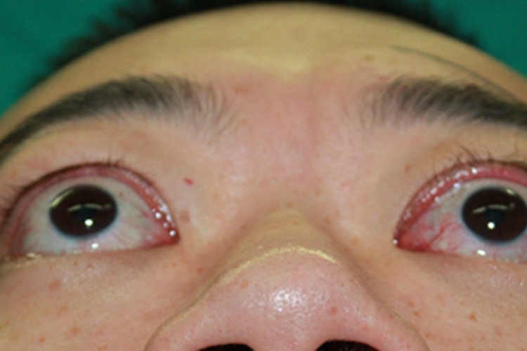 甲状腺相关眼病眼球症状图