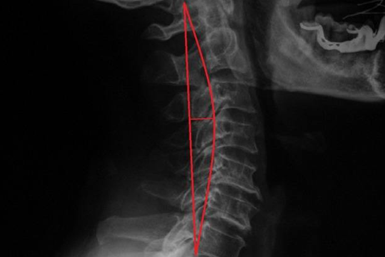 正常颈椎曲度图