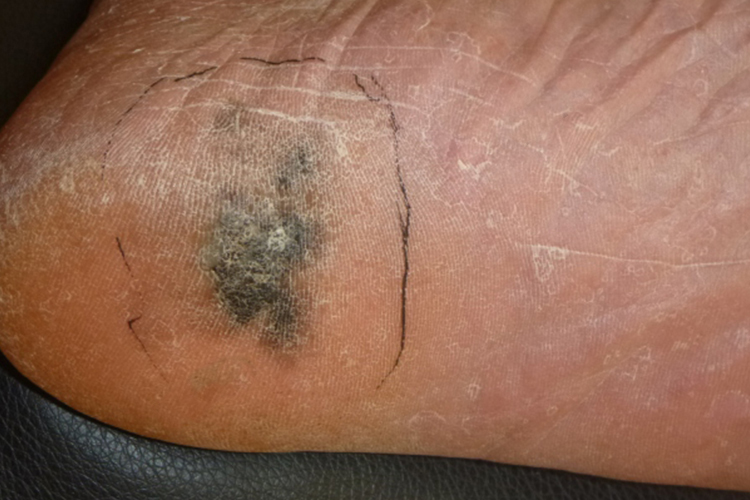 脚底浅表扩散性黑素瘤图