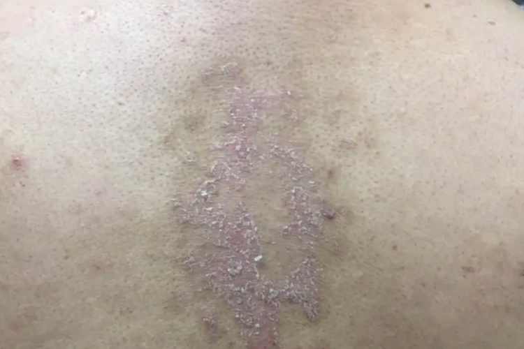 湿疹后背干燥起皮屑图