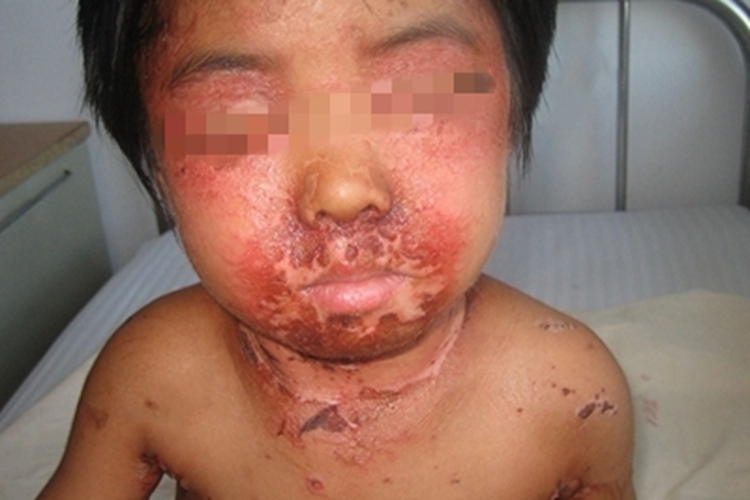 脓疱病口周症状图 脓疱病口周症状图